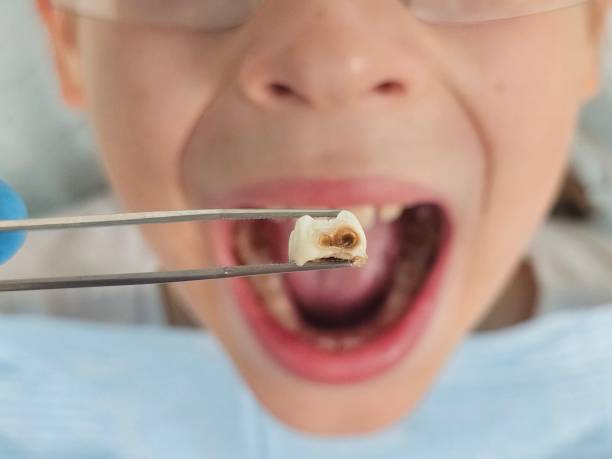 Best Emergency Gum Treatment in Warsaw, VA