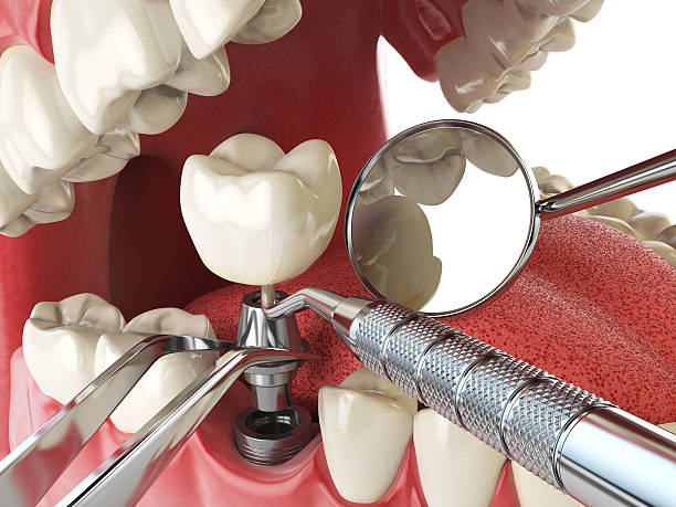 Best Emergency Treatment for Dental Infections or Abscesses in Warsaw, VA